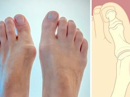 Косточки на ногах: эти 4 натуральных средства эффективно выведут соли и быстро избавят от боли