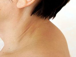 Вдовий горб: почему нужно лечить отложение солей на шее