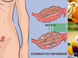 Натуральное средство для лечения поликистоза яичников: никаких гормонов