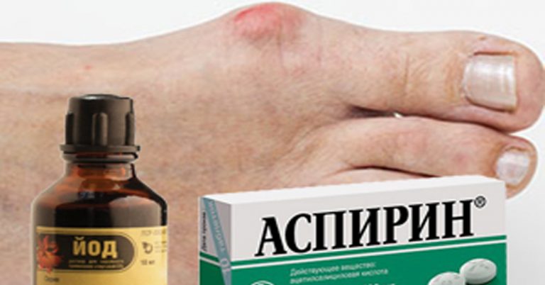 Народными способами быстро убираем косточку на ноге. Большая шишка на ноге растает за неделю