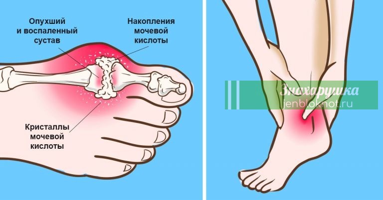 ИЗБАВЬСЯ от мочевой кислоты, а также вылечи подагру. 10 натуральных средств