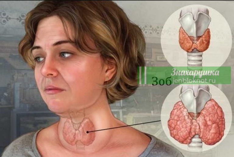 Узловой токсический зоб — просто накопала корни одуванчика ранней весной и избежала удаления щитовидки