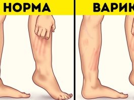 Мазь для лечения узлов на ногах — тромбофлебита и варикоза