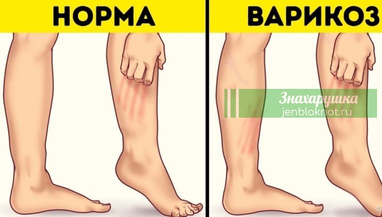 Мазь для лечения узлов на ногах — тромбофлебита и варикоза