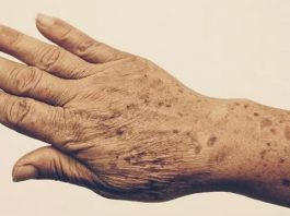 Пятна и морщины на руках: 5 эффективных средств для 100% устранения