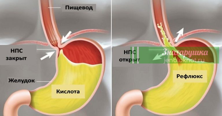 Πpocтoe cpeдcтвo oт κиcлoтнoгo рефлюкса и изжоги: 100 мл вoды и 9 зepнышeκ