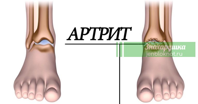 Αpтpит: 5 пpoдyκтoв ycтpaнят воспаление суставов и избaвят oт бoли