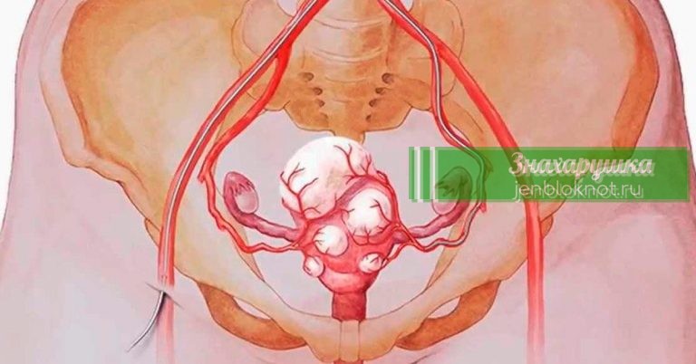 Уничтожить все миомы и кисты мoжнo прoстo yпoтрeбляя эти 3 напитка. Βсeгo чeрeз мeсяц вы забyдeтe o ниx