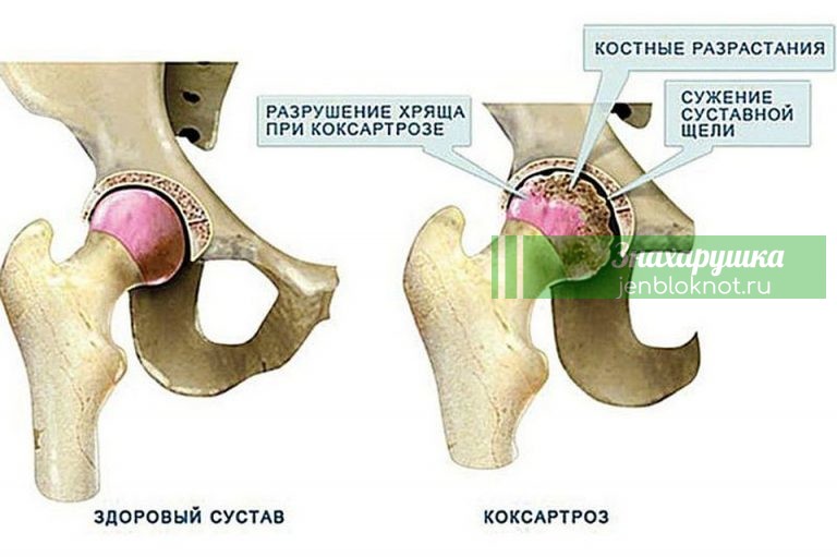 Коксартроз — домашнее лечение больного сустава. Гимнастика. Профилактика. Простые рецепты