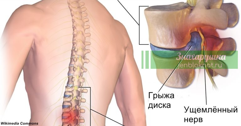 Зарядка, которая поможет справиться с грыжей межпозвоночного диска