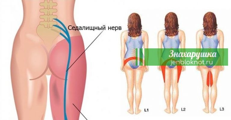 Как же разблокировать седалищный нерв: 2 простых способа снять боль
