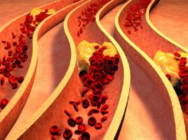 Это 8 тревожных сигналов организма о закупоренных артериях. Лучшие способы избавления