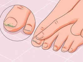 7 народных средств лечения грибка ногтей