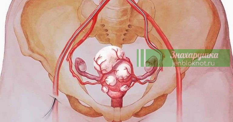 Уничтожить все миомы и кисты можно просто употребляя эти 3 напитка. Всего через месяц вы забудете о них