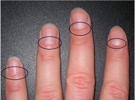 13 проблем со здоровьем, о которых предупреждают лунки на ногтях