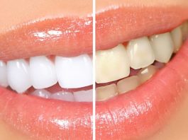 Белые и здоровые зубы: 8 хитростей дают 100% результат