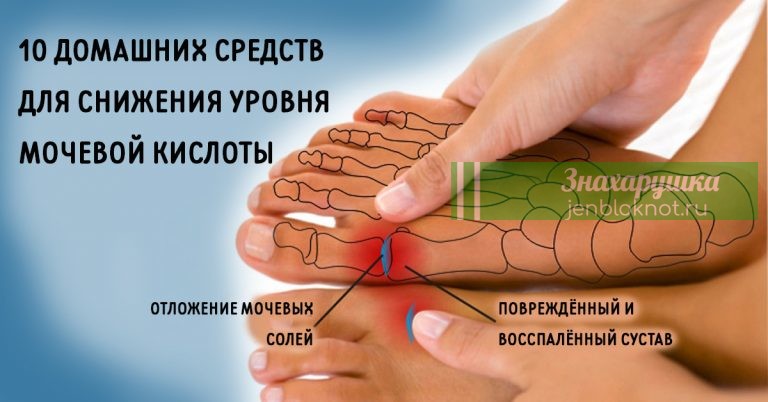 ИЗБАВЬСЯ от мочевой кислоты, а также вылечи подагру. 10 натуральных средств