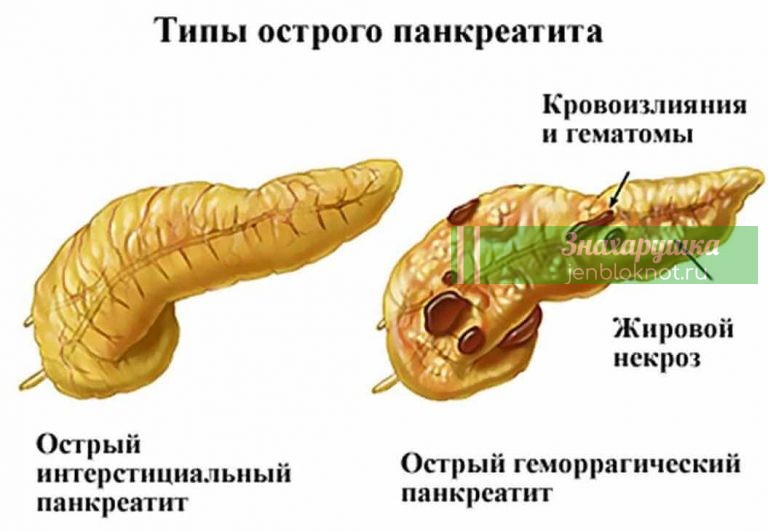Как остановить панкреатит
