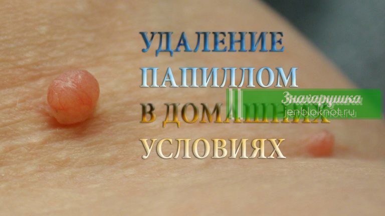 Удали Фибромы без операции