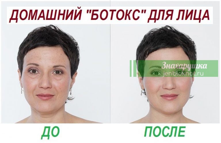 Домашний «ботокс» для лица