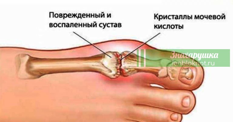 5 старинных проверенных средств устранят мочевую кислоту и избавят от болей в суставах