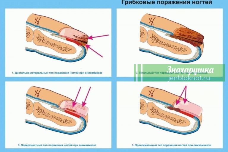 Как вылечить грибок на ногтях