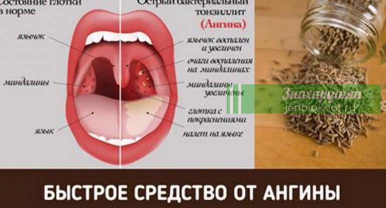 Как избавиться от боли в горле за пару часов