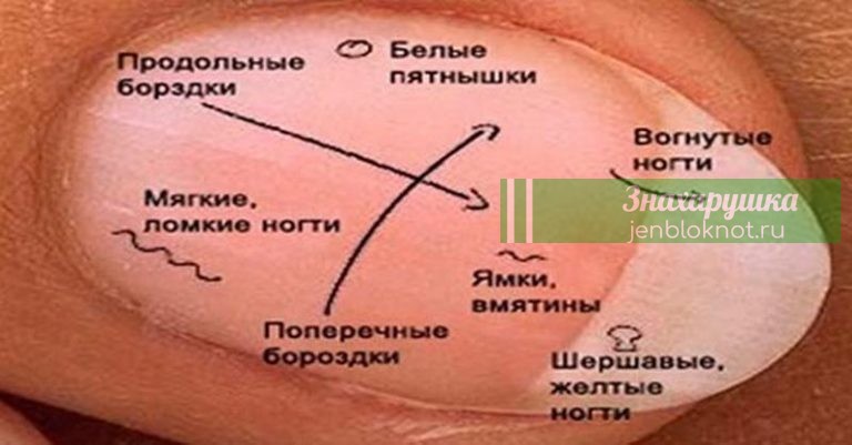 ЧТО ГОВОРЯТ НОГТИ О НАШЕМ ЗДОРОВЬЕ
