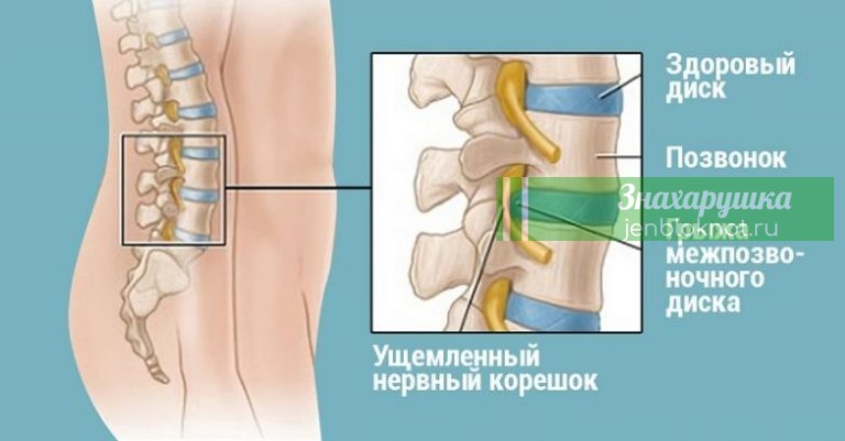 Хирург отговорил дядю от операции, посоветовав делать ЭТИ упражнения…