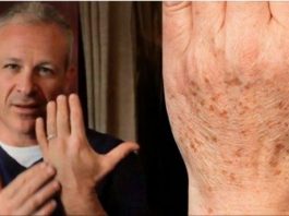 Американский доктор рекомендует: простой трюк быстро устранит пигментные пятна на коже