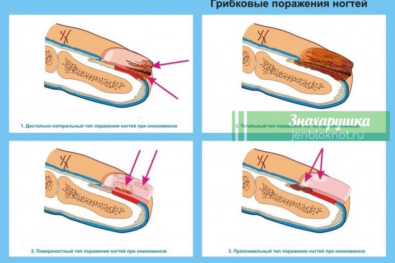 Как вылечить грибок на ногтях