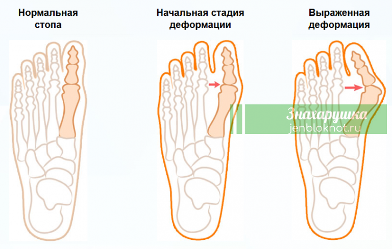 КАК ВЫЛЕЧИТЬ КОСТОЧКУ НА НОГЕ