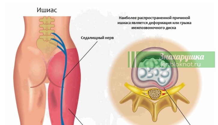 Невралгия, причины, признаки, лечение народными способами