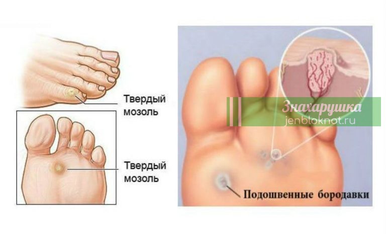 Мозоли и бородавки на ногах: как от них избавиться. Лучший способ, который действительно работает