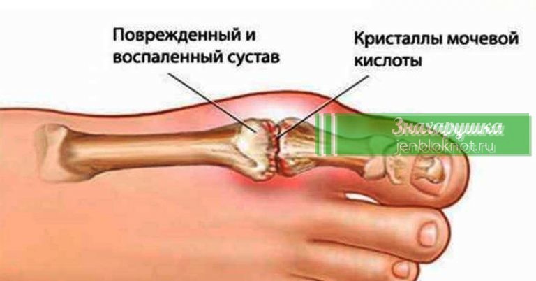 5 старинных проверенных средств устранят мочевую кислоту и избавят от болей в суставах