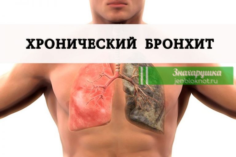 Этим методом можно побороть кашель и бронхит