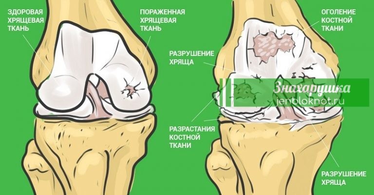 Самый эффективный способ который избавит вас от болей в суставах