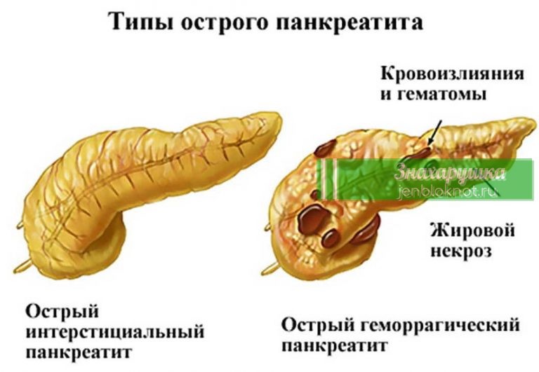 Как остановить панкреатит