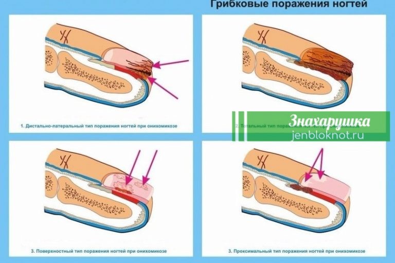 Как вылечить грибок на ногтях