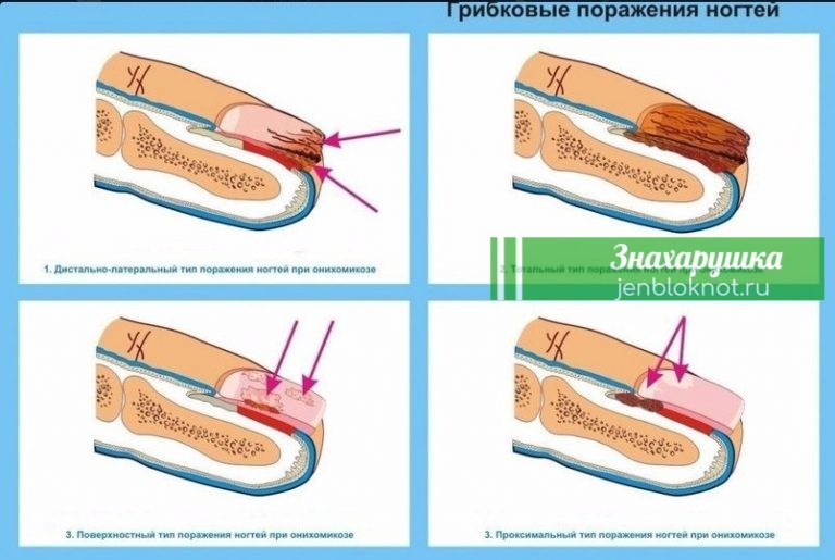 Как вылечить грибок на ногтях