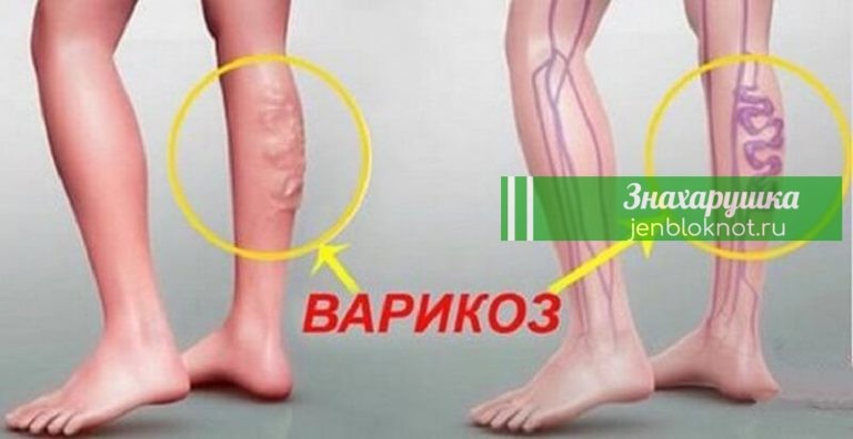 Натуральное Средство против варикоза вен: рецепт, применение