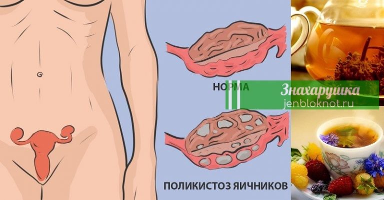 Натуральное средство для лечения поликистоза яичников: никаких гормонов