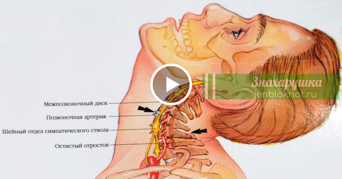 Остеохондроз шейного позвоночника