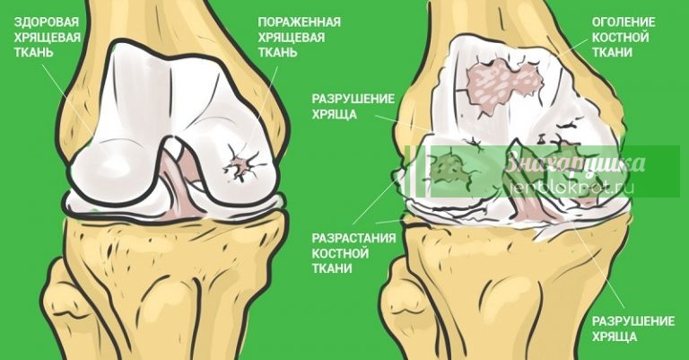 Самый эффективный способ который избавит вас от болей в суставах