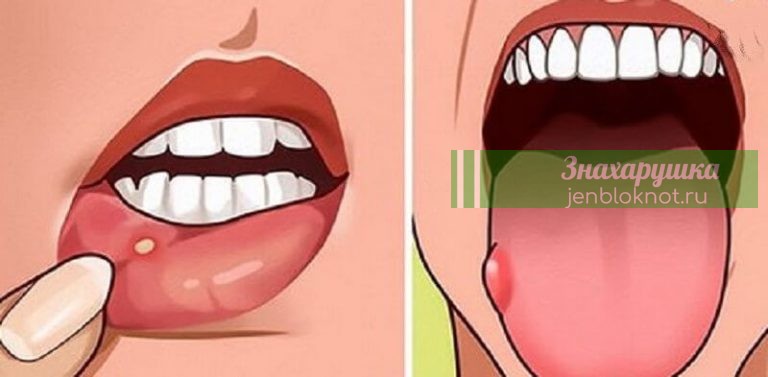 7 признаков дефицита фолиевой кислоты, которые многие игнорируют