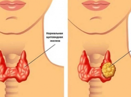 Вот как быстро избавиться от проблем с щитовидной железой