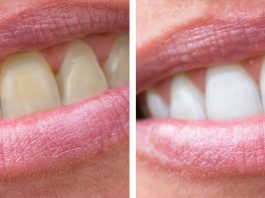 3 минуты процесса, может обеспечить ослепительные белые зубы естественным способом