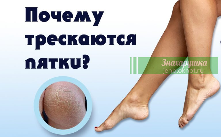 Что делать, если трескаются пятки