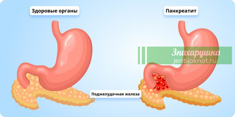 Поджелудочную реально вылечить за 3 недели без медикаментов
