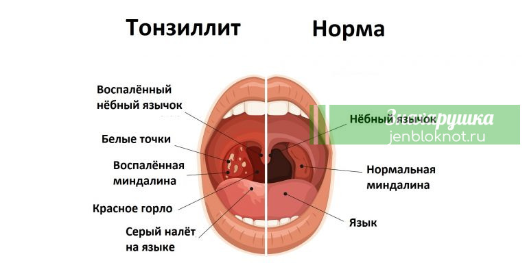 Ангина, тонзиллит и их тяжелые последствия — все лечат эти отличные средства